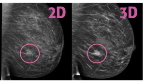 3D Mammogram