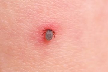 Lyme disease