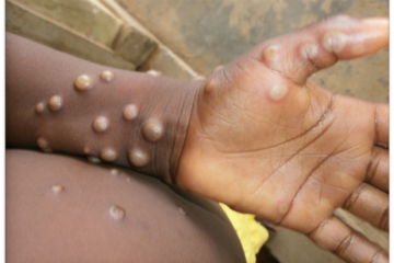 monkeypox
