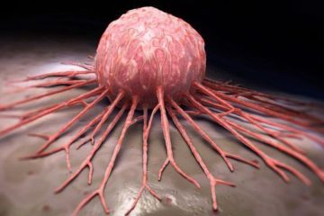 Tumor
